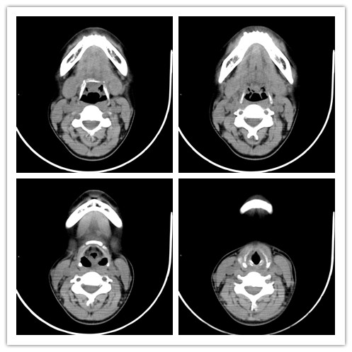 正常喉部CT解剖图片