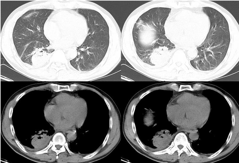 肺脓肿ct影像表现图片